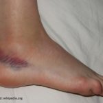 Шины на голени — когда болит нога
